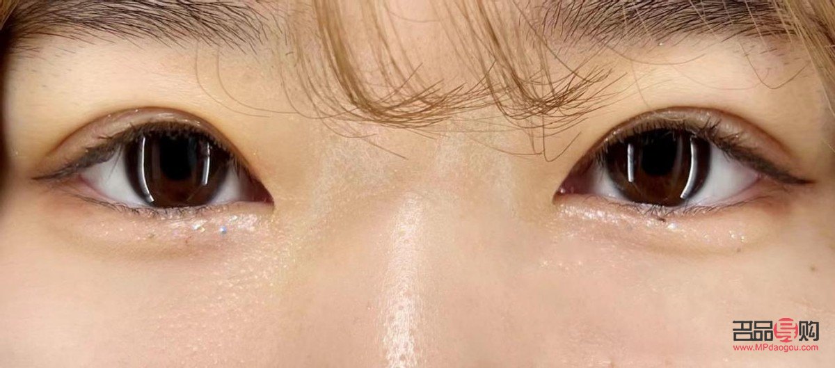 腫眼泡埋線雙眼皮效果能持續(xù)多久？