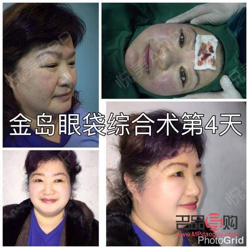 眼袋問題：非手術(shù)解決方案探討