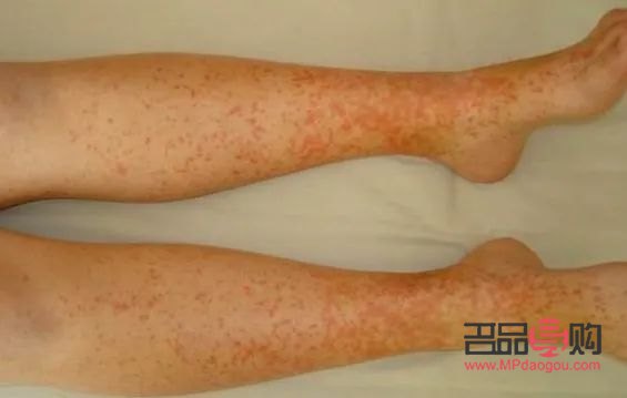 成人低燒怎么護(hù)理身體(成人低燒怎么護(hù)理身體呢)