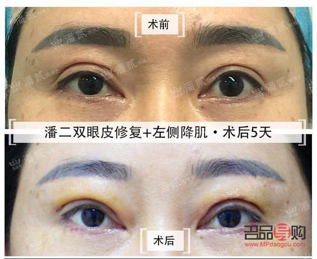 割雙眼皮發(fā)黃說明快好了嗎(割雙眼皮發(fā)黃說明快好了嗎圖片)