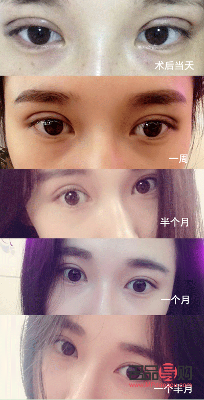 全切雙眼皮1個(gè)月恢復(fù)圖詳解