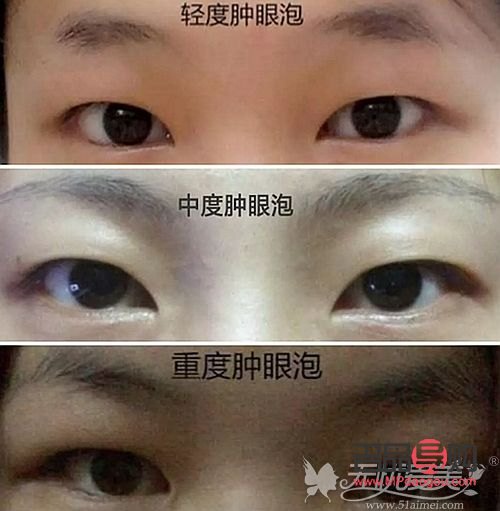腫眼泡手術價格(腫眼泡手術價格是多少)