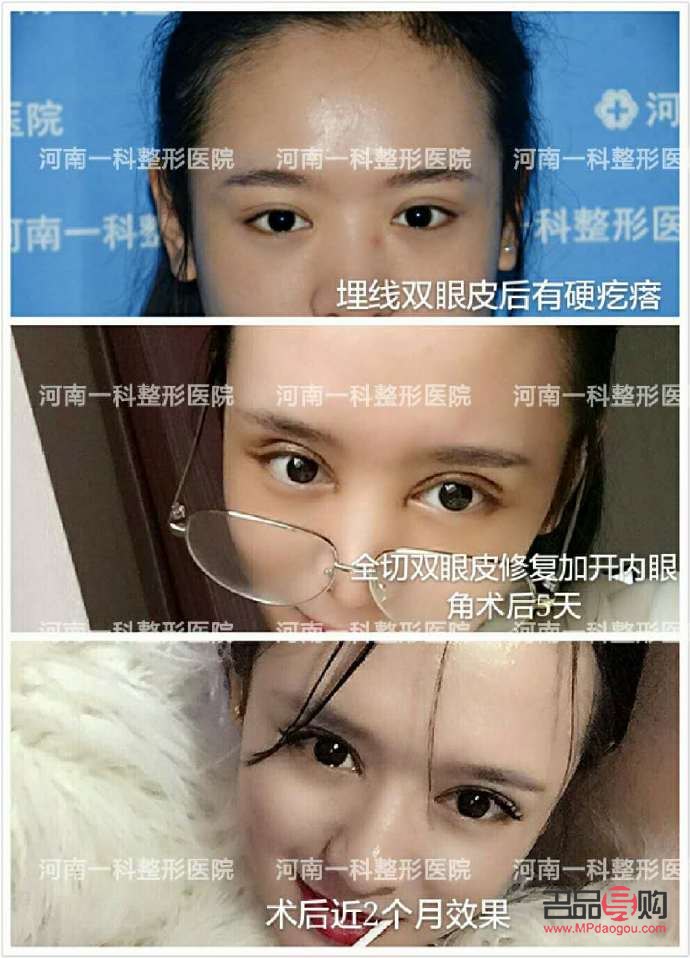 做個雙眼皮多少價錢？了解雙眼皮手術費用及考量因素