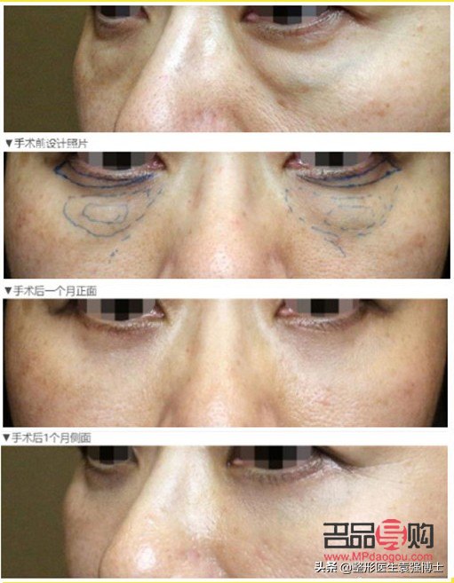 手術去眼袋，眼部健康會受影響嗎？