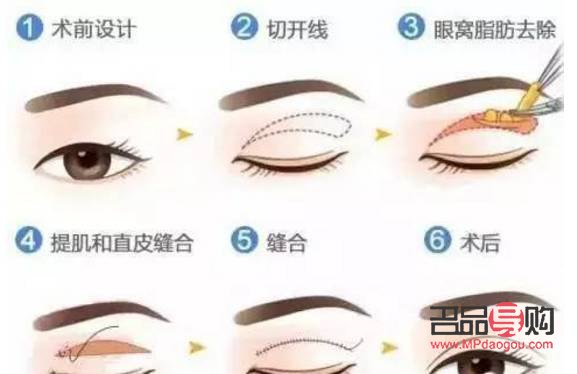 雙眼皮松弛下垂最好解決方法(雙眼皮松弛下垂最好解決方法做手術會難看嗎)