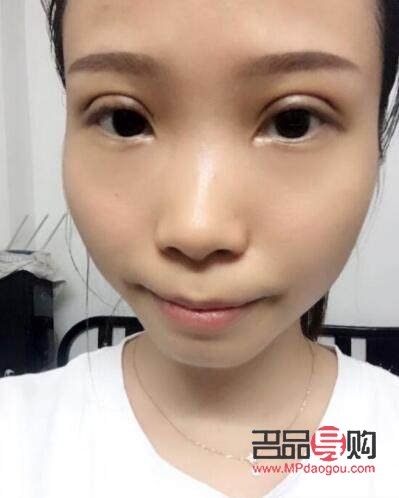 全切雙眼皮手術的后遺癥風險