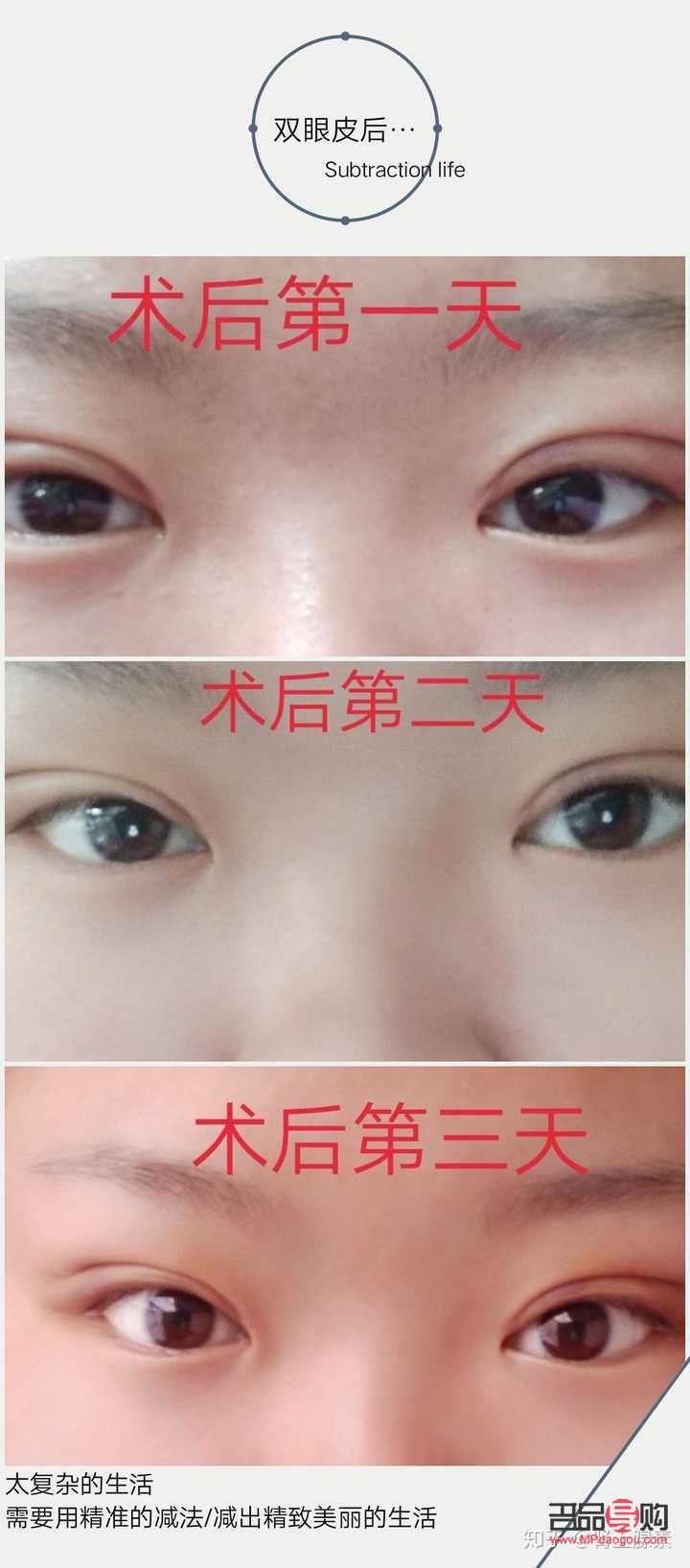 雙眼皮提拉手術可以保持幾年(雙眼皮提拉手術可以保持幾年嗎)
