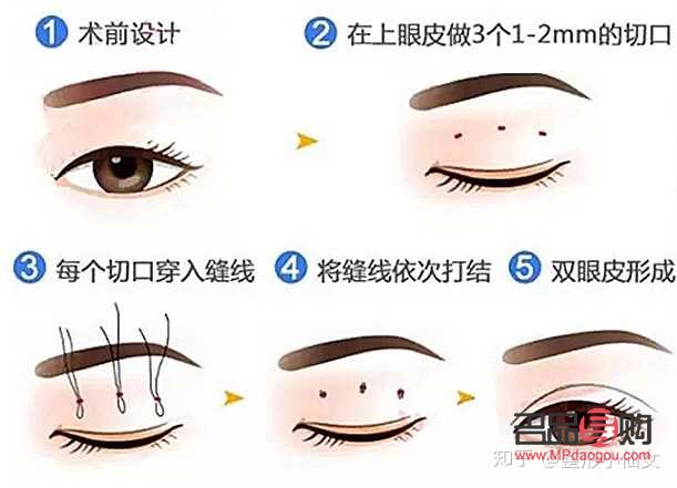 怎樣讓內雙眼皮變成外雙眼皮(怎樣讓內雙眼皮變成外雙眼皮呢)