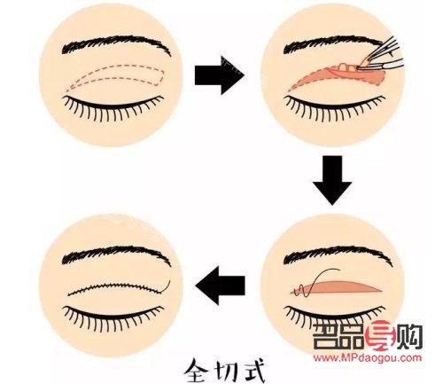 全切雙眼皮示意圖(全切雙眼皮示意圖全過程)