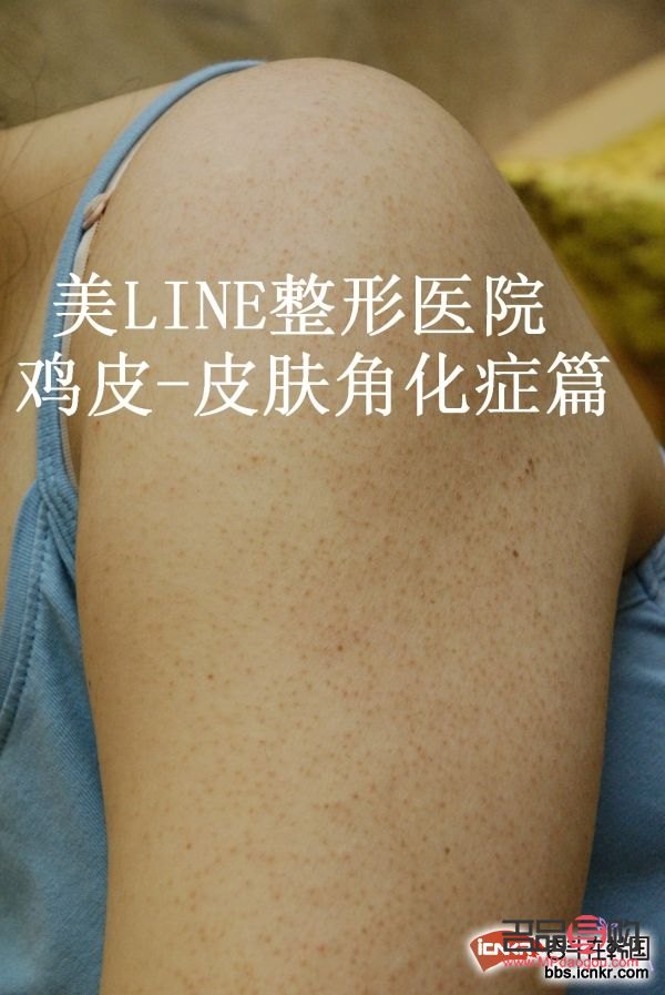 身體護理祛雞皮效果探討