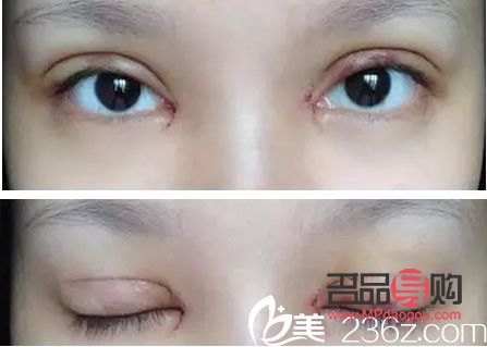 雙眼皮7mm恢復后多寬圖片男(雙眼皮7mm恢復后多寬圖片男生)