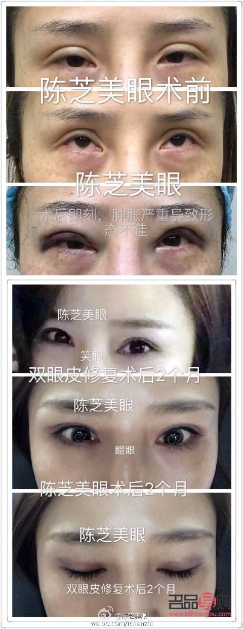 雙眼皮手術對老年時期的影響探究