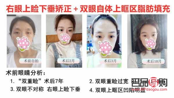 對眼矯正手術多少錢安陽市(對眼矯正的最佳年齡)