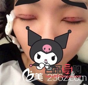 <h3>選擇最佳季節割雙眼皮，美麗更需安全相伴</h3>
