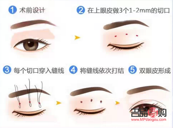 <h3>選擇最佳季節割雙眼皮，美麗更需安全相伴</h3>