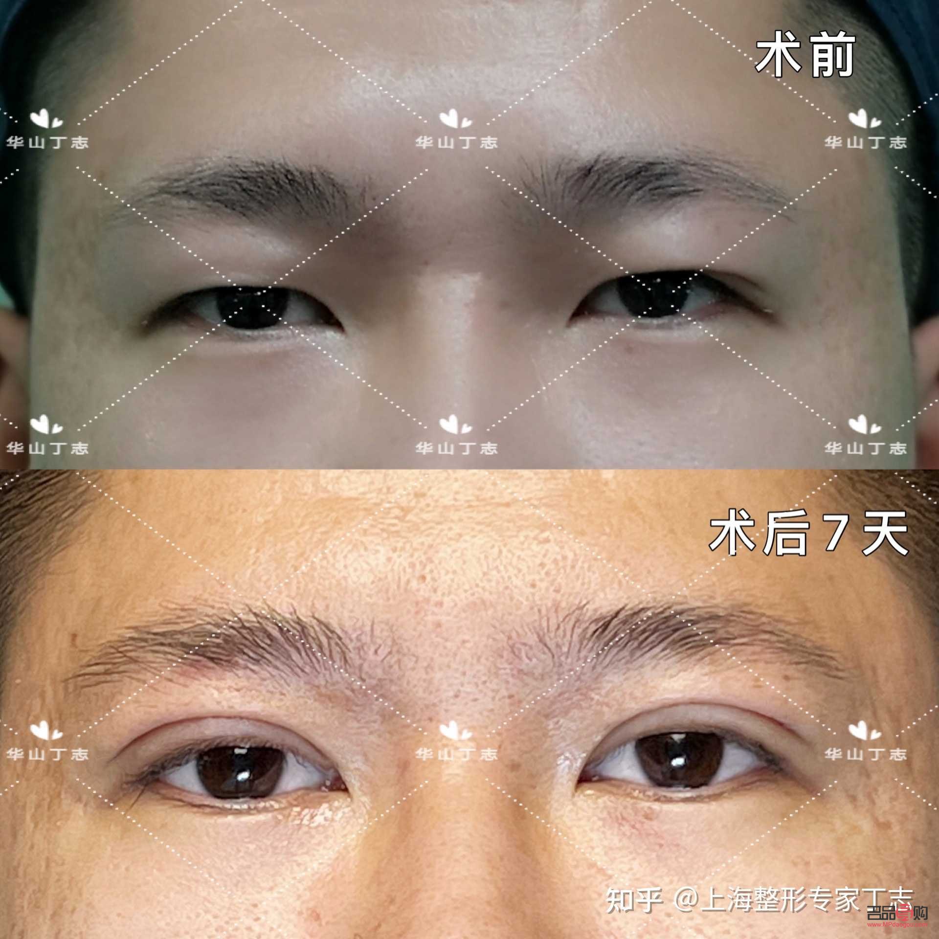 男人腫眼泡需要做什么手術(男人腫眼泡需要做什么手術?)