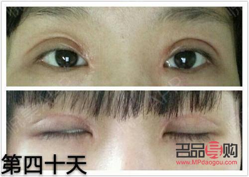 內雙與雙眼皮手術：值得考慮的選擇？