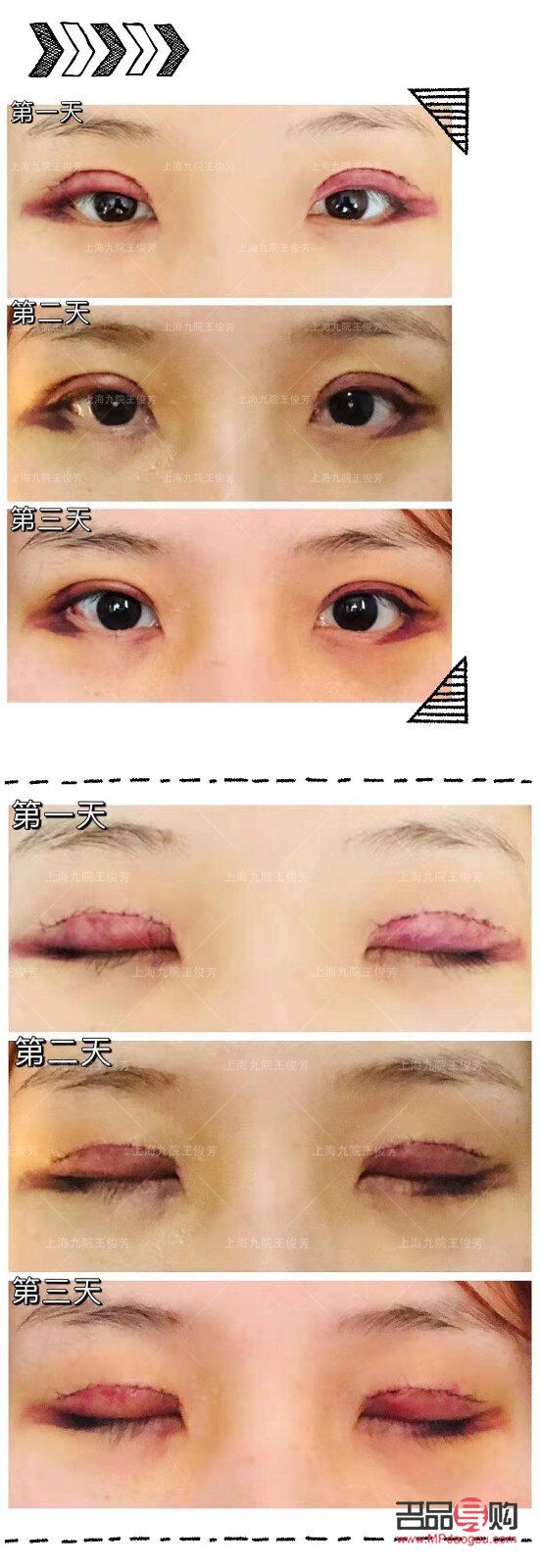 探尋最佳雙眼皮效果：哪款雙眼皮手術效果最理想？