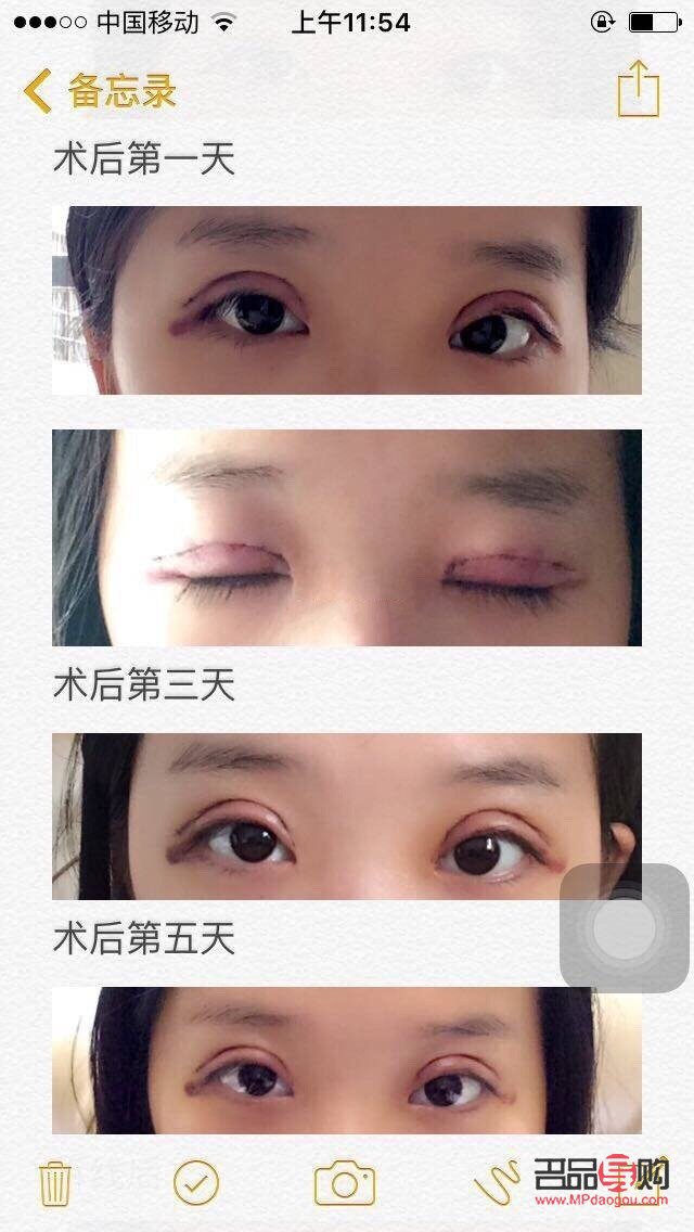 全切雙眼皮可以做幾次(全切雙眼皮可以做幾次修復)