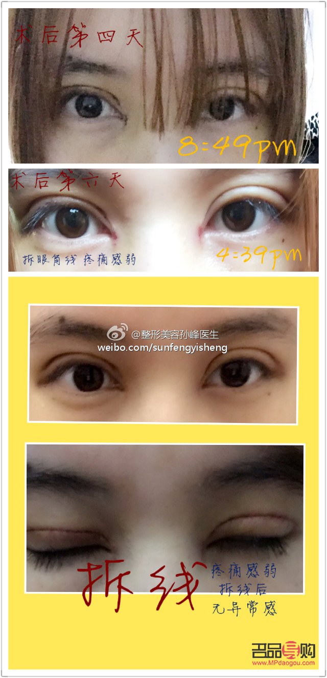 雙眼皮剛拆線效果圖解析及術后護理指南