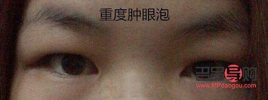 <h3>探究小朋友眼泡腫脹的成因</h3>