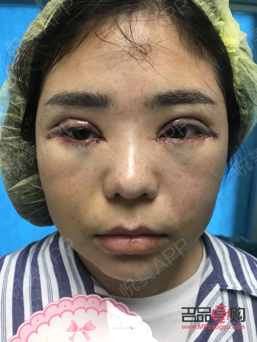 雙眼皮手術后，冰敷眼睛的正確方式