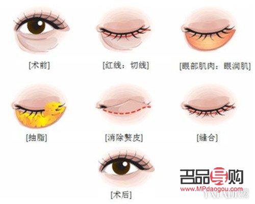 眼部抽脂手術費用及注意事項