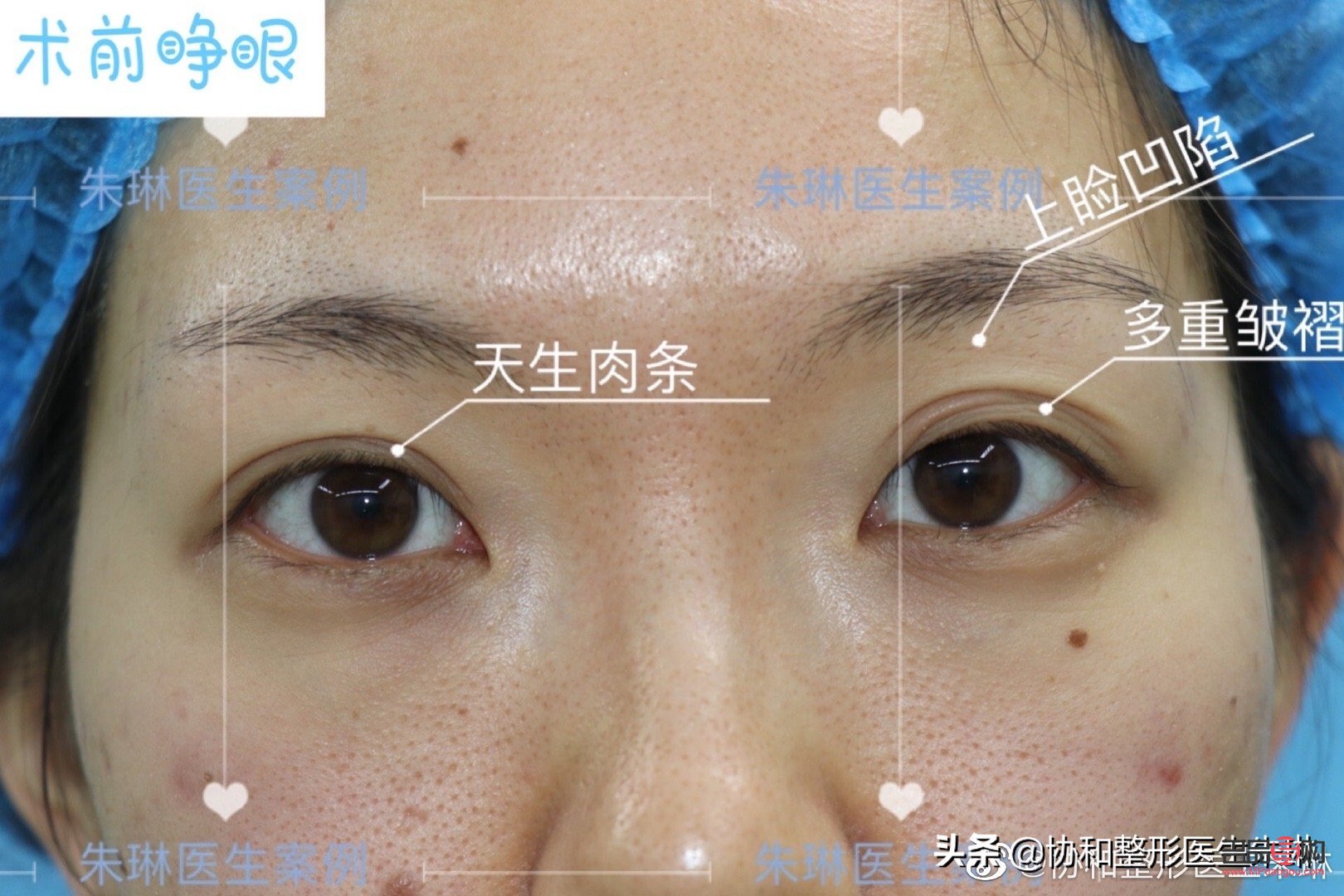 全切雙眼皮：美麗與風險并存的選擇