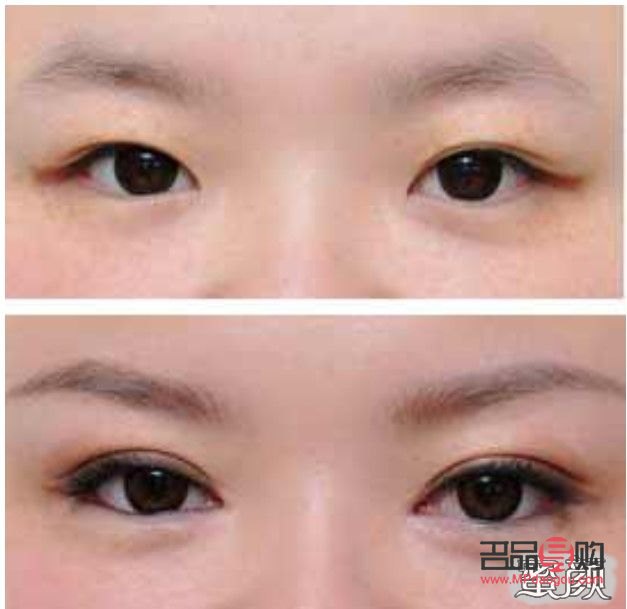 <h3>雙眼皮手術(shù)選擇指南：打造自然迷人的雙眼</h3>