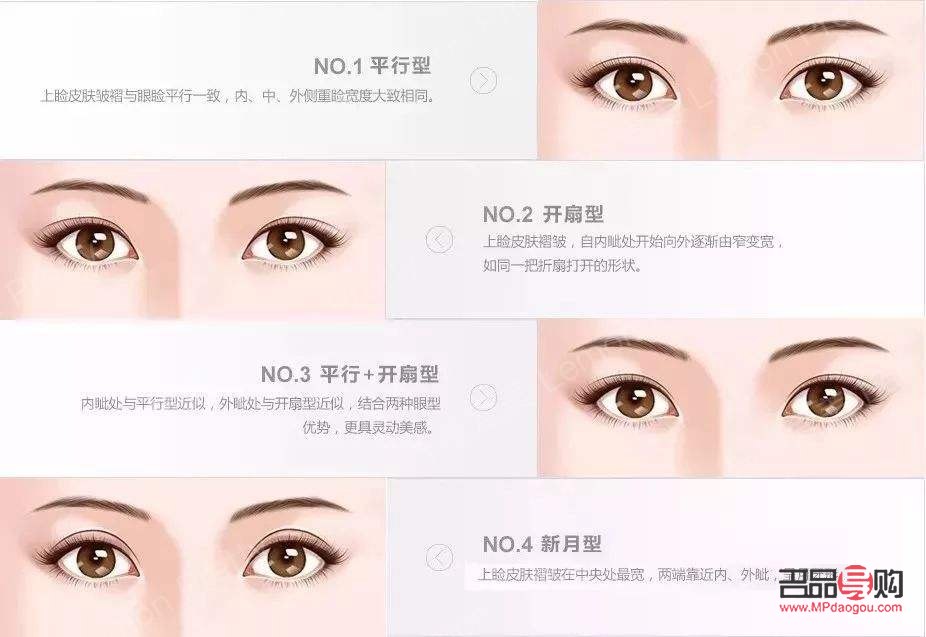 雙眼皮種類圖片全解析