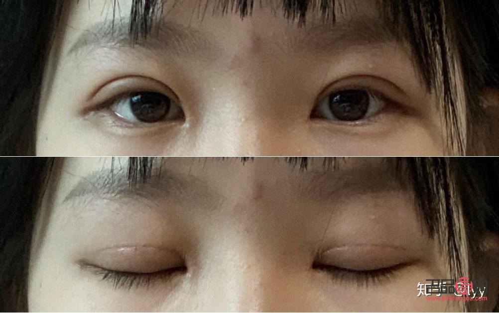 開扇雙眼皮恢復過程全解析