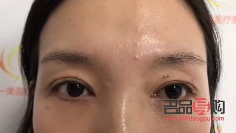 <h3>眼皮一邊內(nèi)雙一邊外雙怎么辦？解決雙眼皮不對稱問題全攻略</h3>