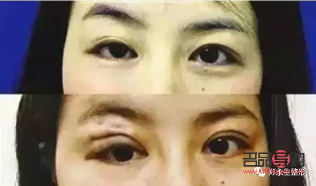 眼皮一邊內雙一邊外雙怎么辦？解決雙眼皮不對稱問題全攻略