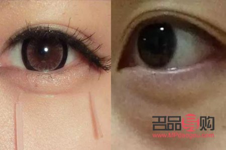 臥蠶與眼袋：笑容中的微妙差異