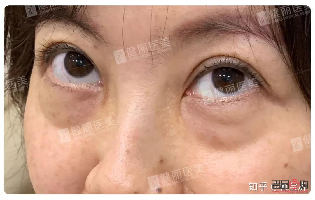 <h3>15歲有眼袋，原因何在？</h3>