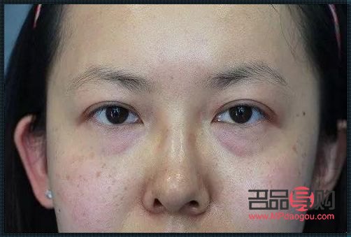 15歲有眼袋，原因何在？