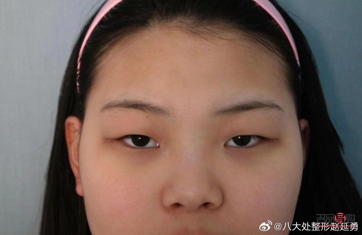 <h3>腫眼泡手術后是否會再次復發？</h3>
