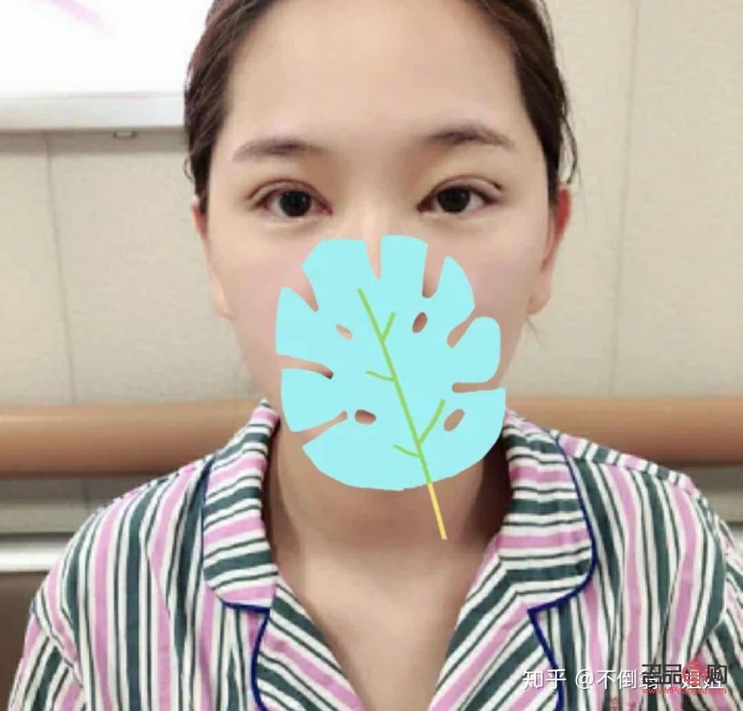 <h3>腫眼泡手術后是否會再次復發？</h3>