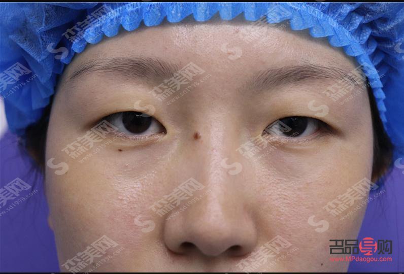 腫眼泡手術(shù)后是否會(huì)再次復(fù)發(fā)？