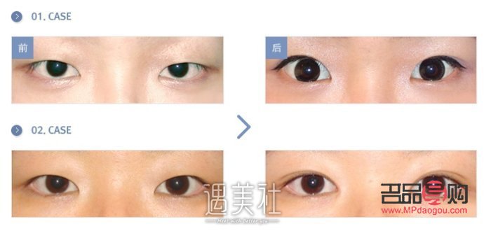 &amp;lt;h1&amp;gt;內眼角開太大了怎么辦？專業解答與應對策略&amp;lt;/h1&amp;gt;