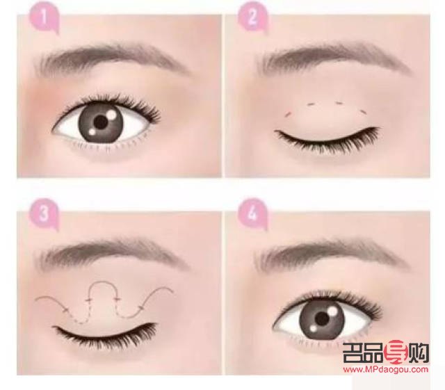 什么叫假性雙眼皮(什么叫假性雙眼皮手術)