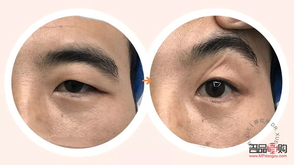 做雙眼皮提肌與不提肌的區別案例(雙眼皮提肌和不提肌的圖片對比)