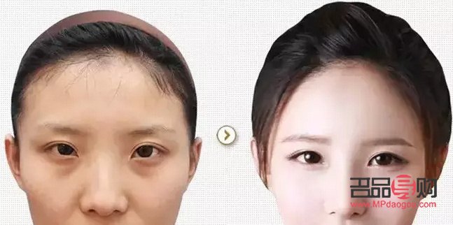 內雙適不適合割雙眼皮(內雙適不適合割雙眼皮手術)