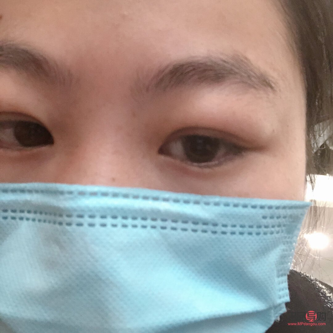 <h3>天生腫眼泡熱敷是否有用？</h3>