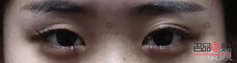 <h3>大小眼手術失?。涸?、影響與應對策略</h3>