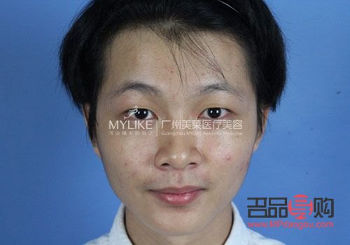 <h3>大小眼手術失?。涸?、影響與應對策略</h3>