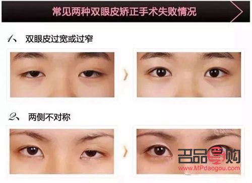 大小眼手術(大小眼手術多久恢復)