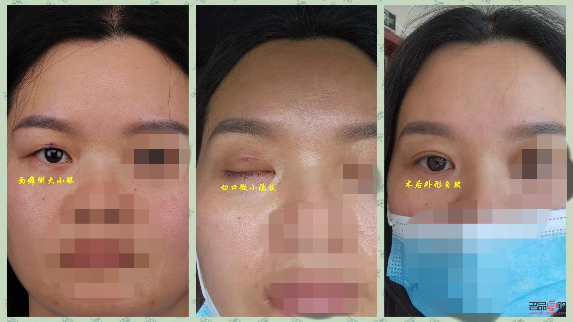 大小眼手術(大小眼手術多久恢復)
