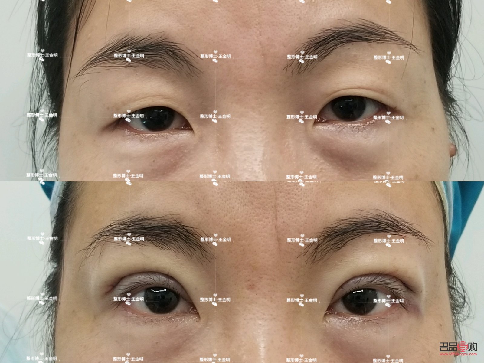 大小眼手術(大小眼手術多久恢復)