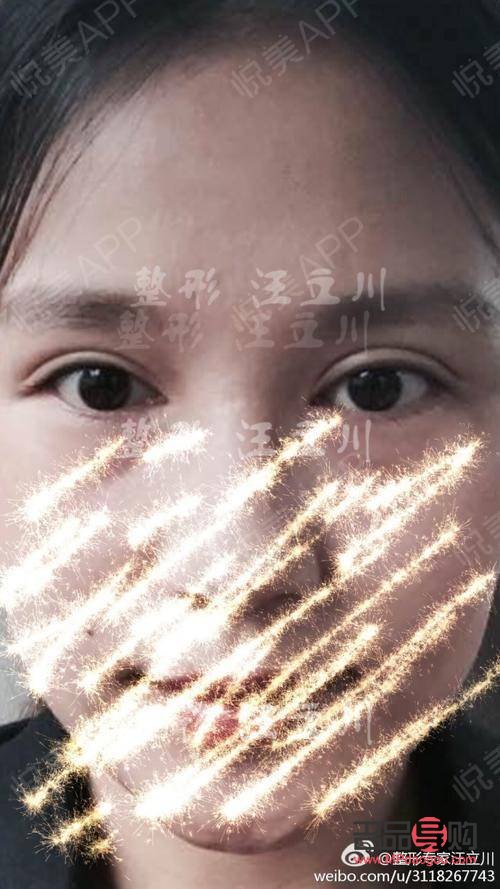 雙眼皮太寬能否改窄？專業解答與操作建議